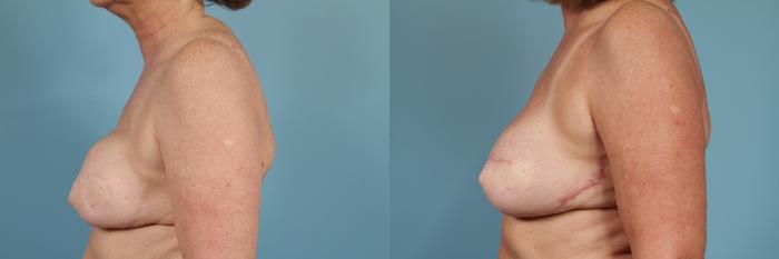 Before & After Breast Reconstruction Case 210 View #2 View in Chicago, IL