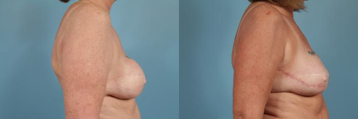 Before & After Breast Reconstruction Case 210 View #3 View in Chicago, IL