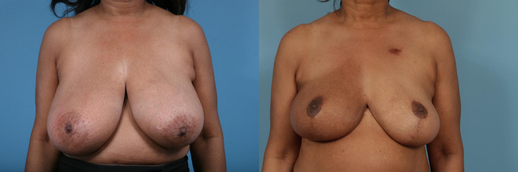 Before & After Breast Reconstruction Case 219 View #1 View in Chicago, IL