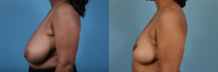 Before & After Breast Reconstruction Case 219 View #2 View in Chicago, IL