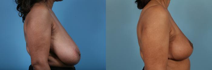 Before & After Breast Reconstruction Case 219 View #3 View in Chicago, IL