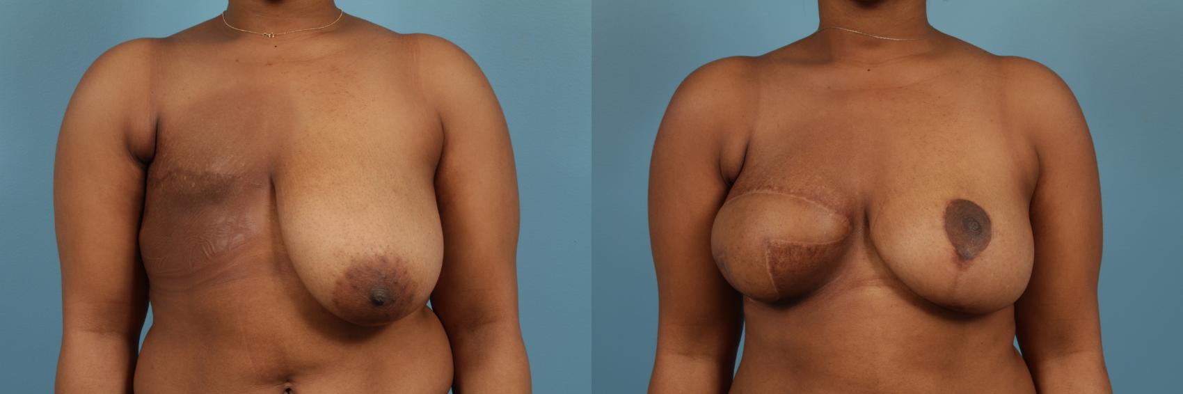 Before & After Breast Reconstruction Case 221 View #1 View in Chicago, IL