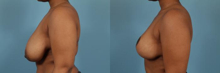 Before & After Breast Reconstruction Case 221 View #2 View in Chicago, IL