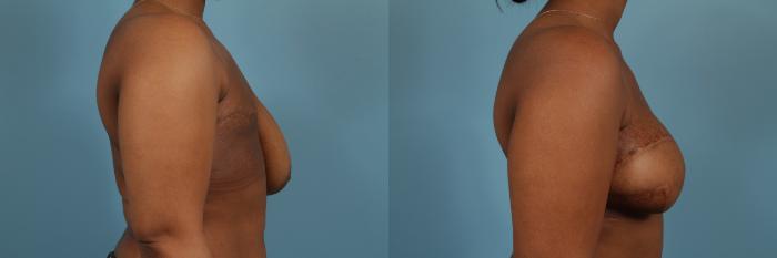 Before & After Breast Reconstruction Case 221 View #3 View in Chicago, IL