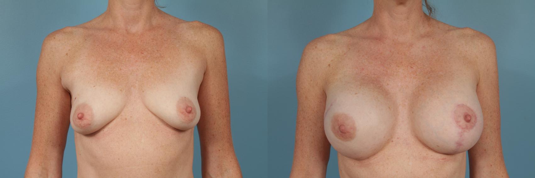 Before & After Breast Reconstruction Case 238 View #1 View in Chicago, IL