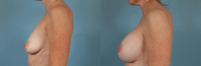 Before & After Breast Reconstruction Case 238 View #2 View in Chicago, IL