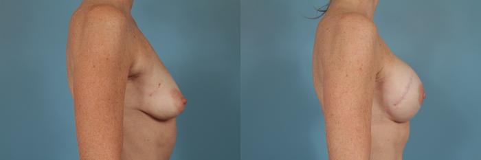 Before & After Breast Reconstruction Case 238 View #3 View in Chicago, IL
