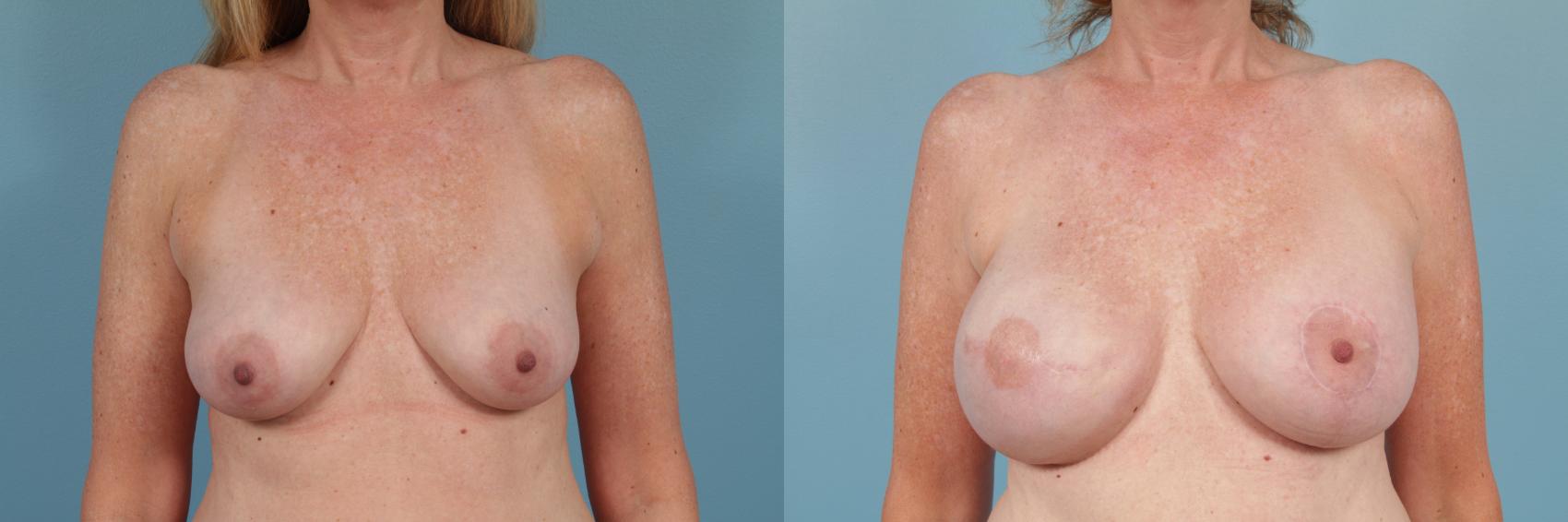 Before & After Breast Reconstruction Case 249 View #1 View in Chicago, IL