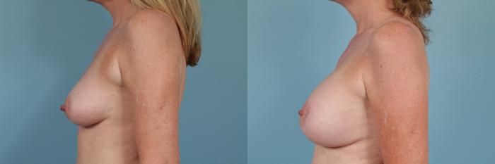 Before & After Breast Reconstruction Case 249 View #2 View in Chicago, IL