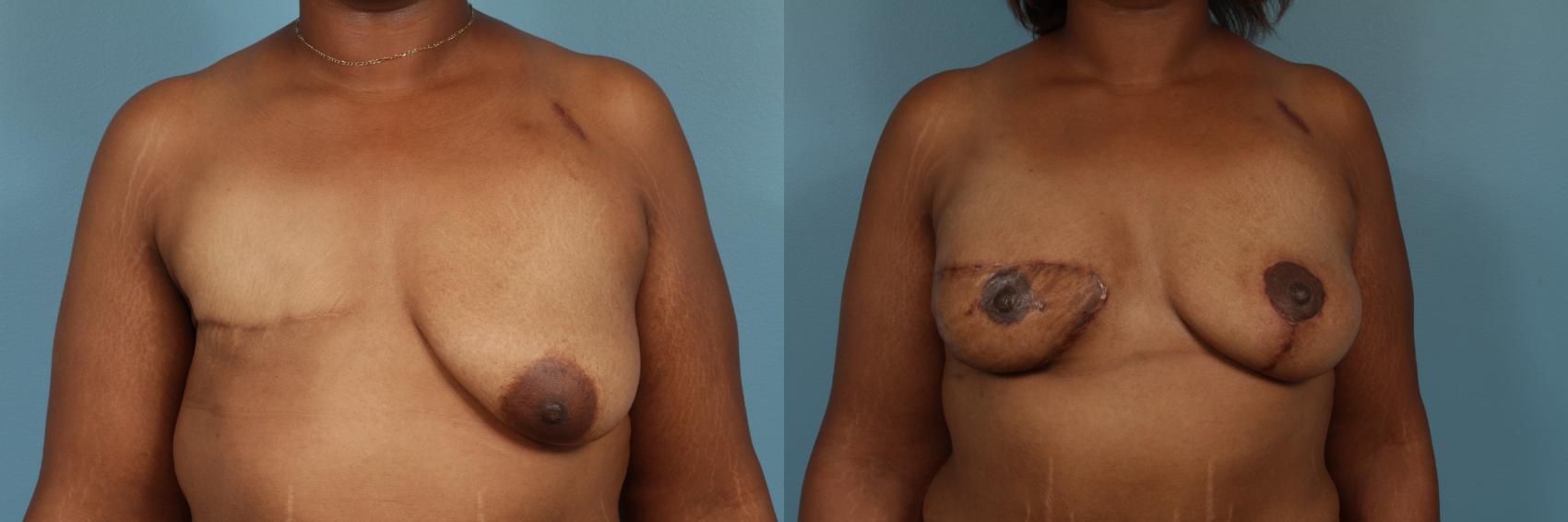 Before & After Breast Reconstruction Case 250 View #1 View in Chicago, IL