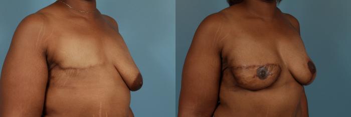 Before & After Breast Reconstruction Case 250 View #2 View in Chicago, IL