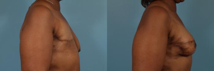 Before & After Breast Reconstruction Case 250 View #3 View in Chicago, IL