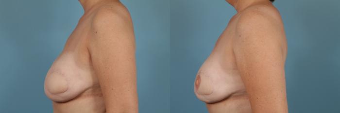 Before & After Breast Reconstruction Case 255 View #2 View in Chicago, IL
