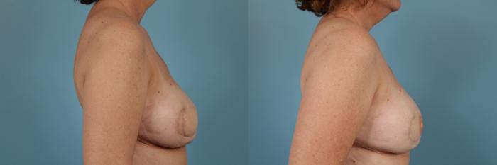 Before & After Breast Reconstruction Case 255 View #3 View in Chicago, IL