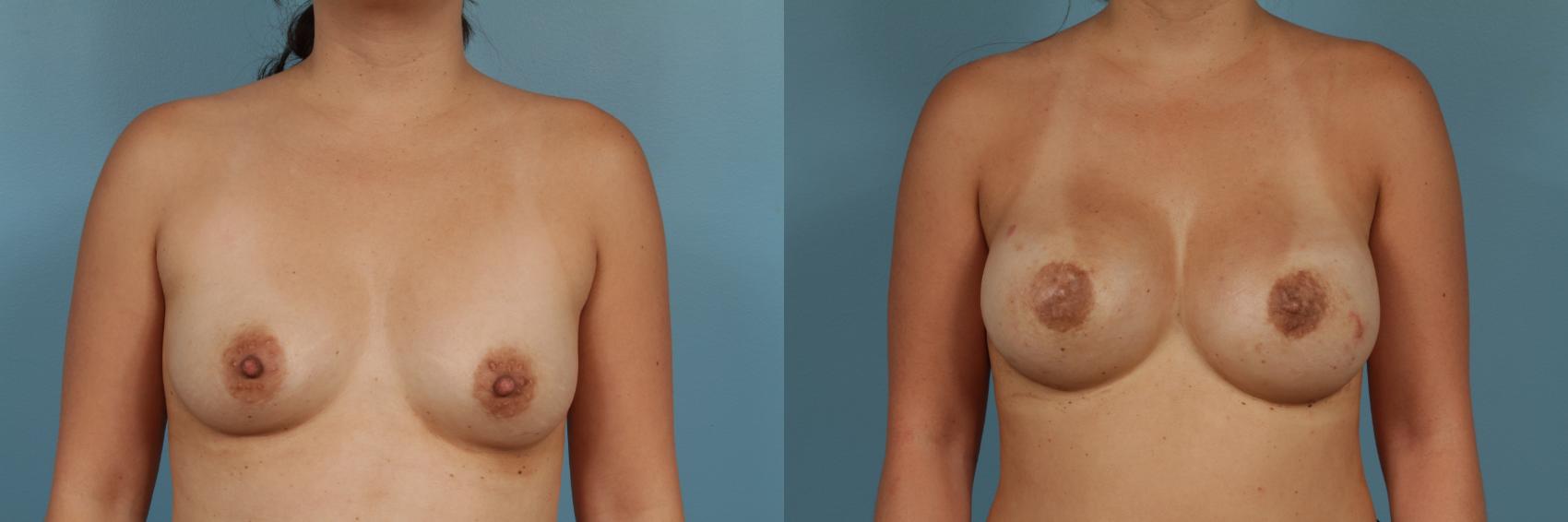 Before & After Breast Reconstruction Case 318 View #1 View in Chicago, IL