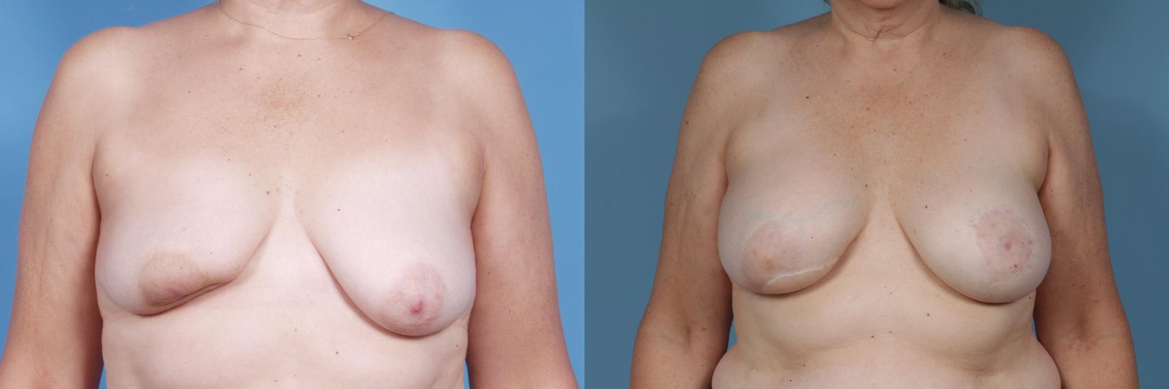 Before & After Breast Reconstruction Case 366 View #1 View in Chicago, IL