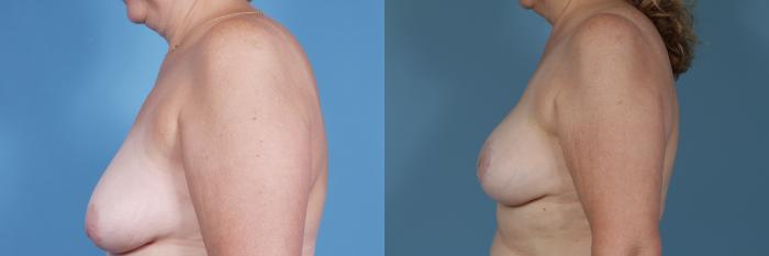 Before & After Breast Reconstruction Case 366 View #2 View in Chicago, IL