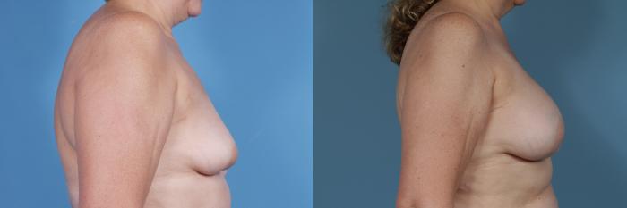 Before & After Breast Reconstruction Case 366 View #3 View in Chicago, IL