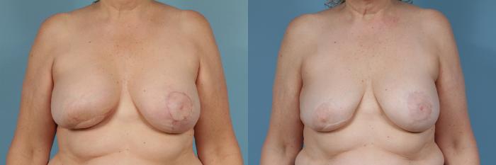 Before & After Breast Reconstruction Case 366 View #4 View in Chicago, IL