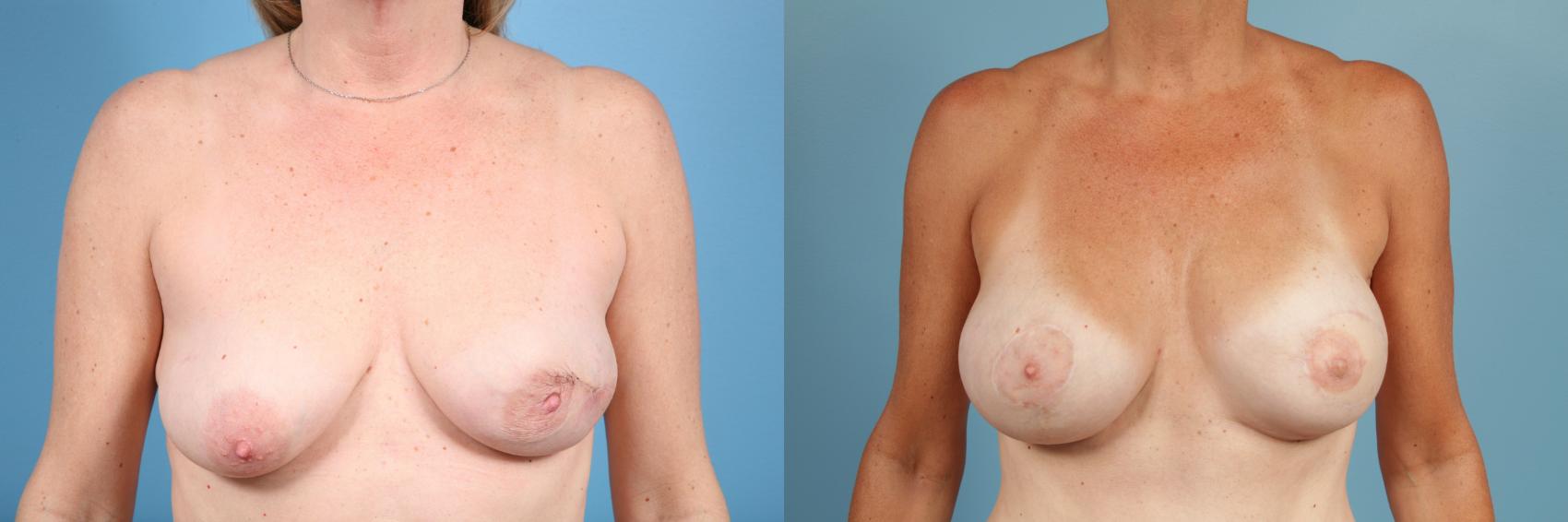 Before & After Breast Reconstruction Case 55 View #1 View in Chicago, IL