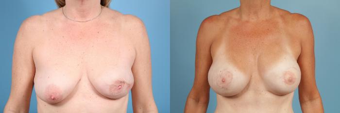 Before & After Breast Reconstruction Case 55 View #1 View in Chicago, IL