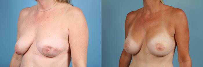 Before & After Breast Reconstruction Case 55 View #2 View in Chicago, IL