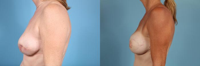 Before & After Breast Reconstruction Case 55 View #3 View in Chicago, IL