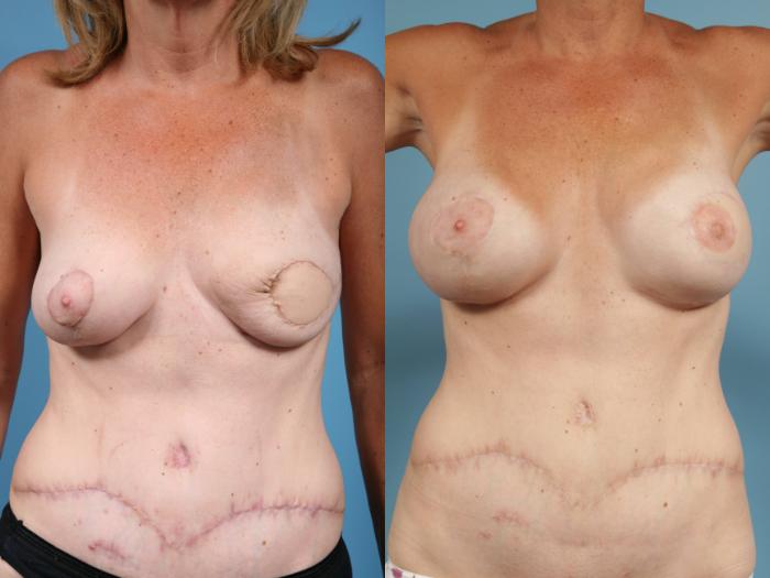 Before & After Breast Reconstruction Case 55 View #5 View in Chicago, IL