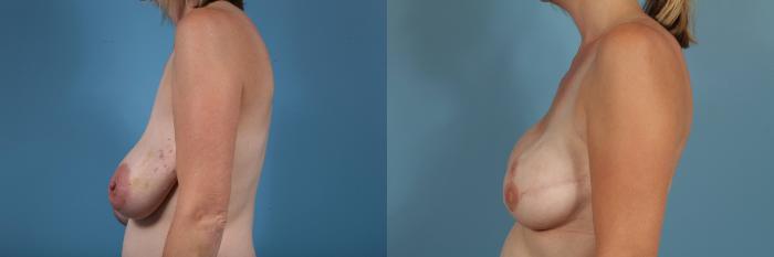 Before & After Breast Reconstruction Case 78 View #5 View in Chicago, IL