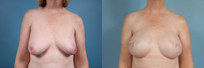 Before & After Breast Reconstruction Case 84 View #1 View in Chicago, IL
