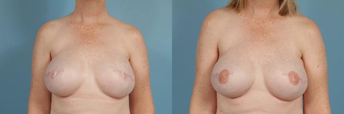 Before & After Breast Reconstruction Case 84 View #2 View in Chicago, IL
