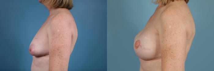 Before & After Breast Reconstruction Case 84 View #3 View in Chicago, IL