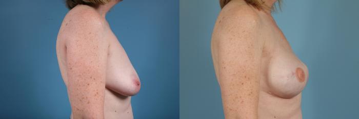 Before & After Breast Reconstruction Case 84 View #4 View in Chicago, IL