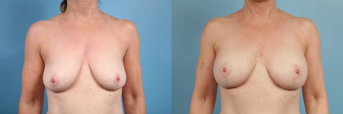 Before & After Breast Reduction Case 101 View #1 View in Chicago, IL