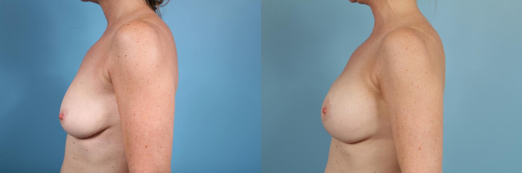 Before & After Breast Reduction Case 101 View #2 View in Chicago, IL