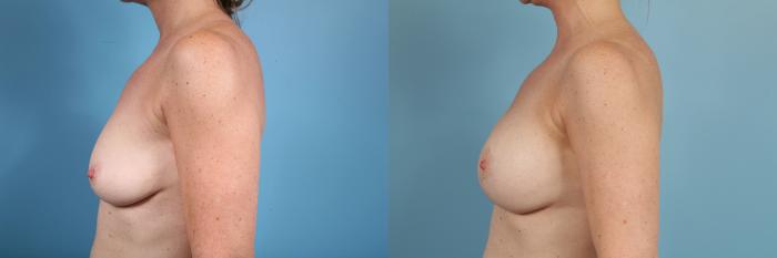 Before & After Breast Reduction Case 101 View #2 View in Chicago, IL