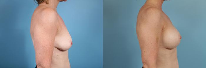 Before & After Breast Reduction Case 101 View #3 View in Chicago, IL