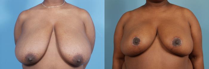 Before & After Breast Reduction Case 112 View #1 View in Chicago, IL