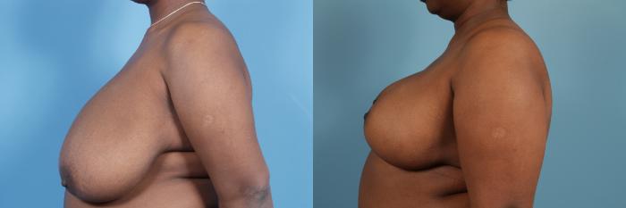 Before & After Breast Reduction Case 112 View #2 View in Chicago, IL
