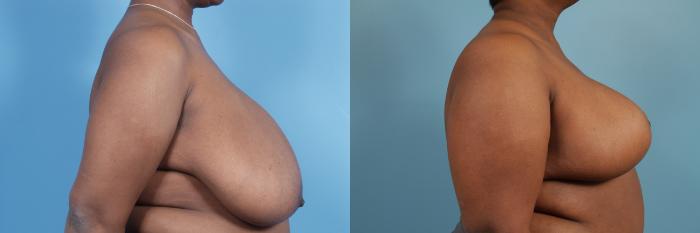 Before & After Breast Reduction Case 112 View #3 View in Chicago, IL