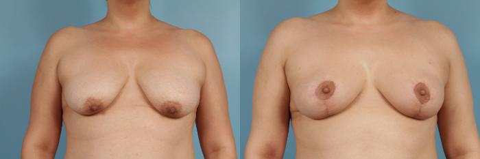 Before & After Breast Reduction Case 114 View #1 View in Chicago, IL