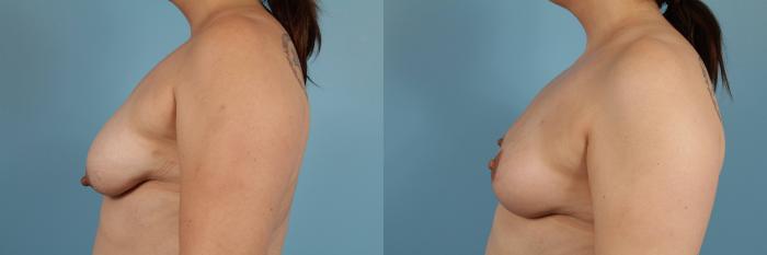 Before & After Breast Reduction Case 114 View #2 View in Chicago, IL