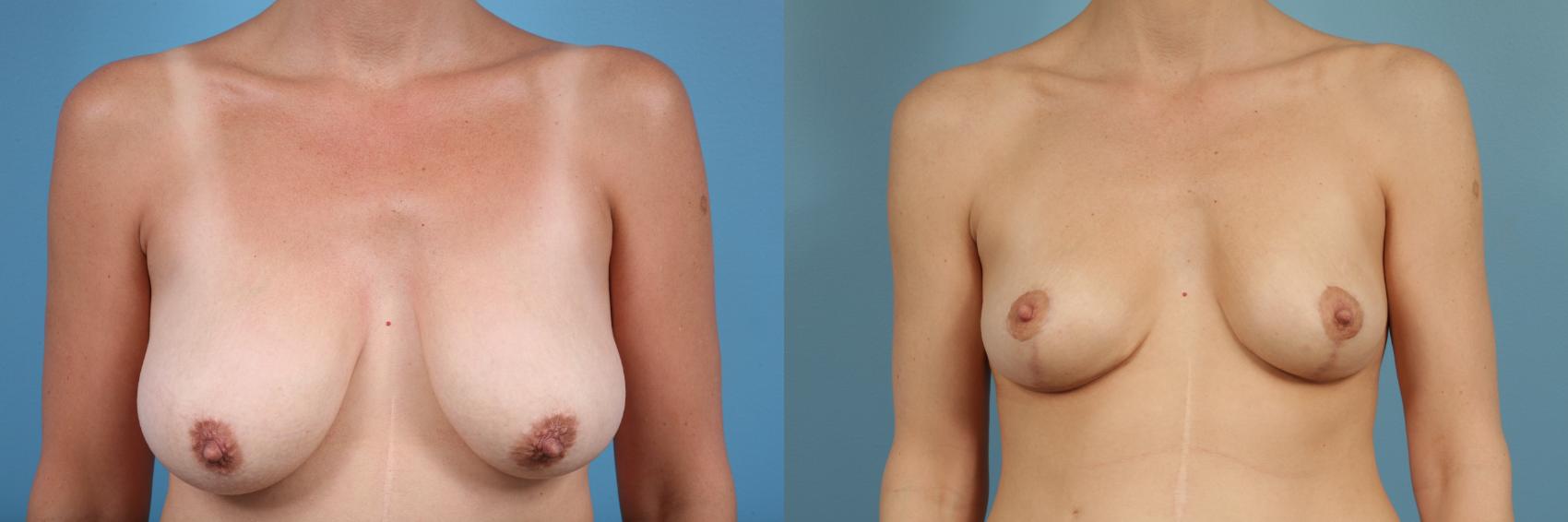 Before & After Breast Reduction Case 115 View #1 View in Chicago, IL