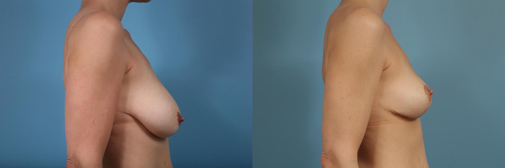 Before & After Breast Reduction Case 115 View #3 View in Chicago, IL