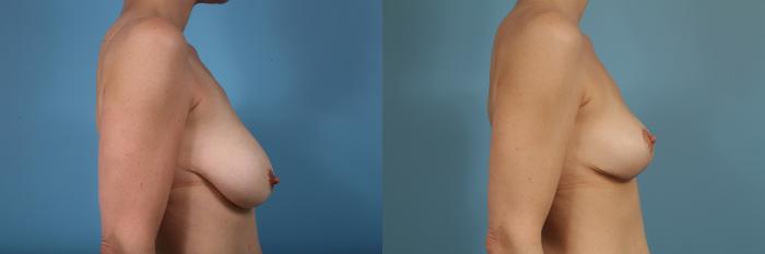 Before & After Breast Reduction Case 115 View #3 View in Chicago, IL