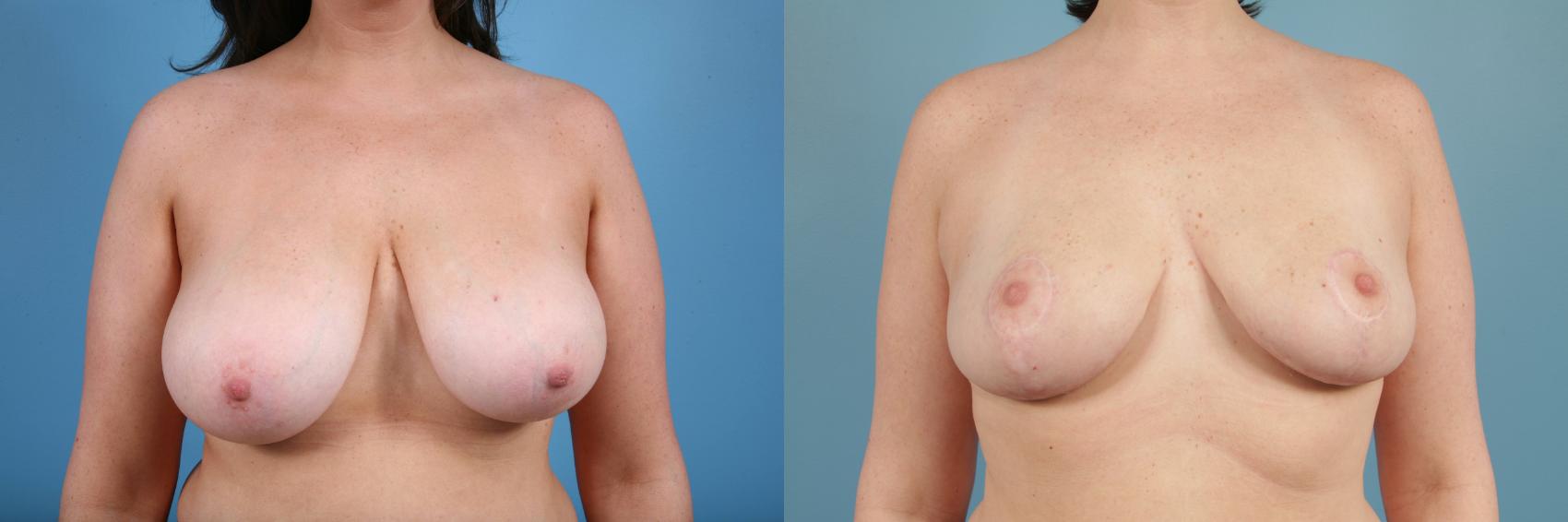 Before & After Breast Reduction Case 116 View #1 View in Chicago, IL