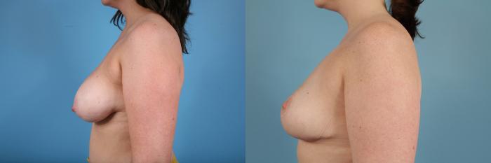 Before & After Breast Reduction Case 116 View #2 View in Chicago, IL