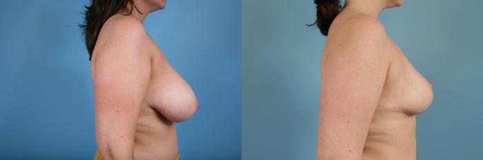 Before & After Breast Reduction Case 116 View #3 View in Chicago, IL