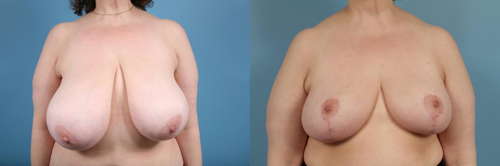 Before & After Breast Reduction Case 129 View #1 View in Chicago, IL