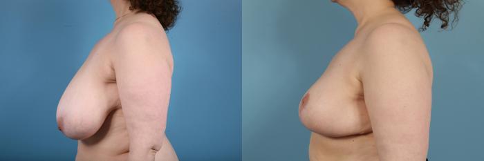 Before & After Breast Reduction Case 129 View #2 View in Chicago, IL